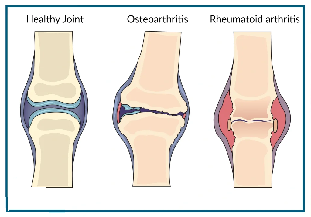 arthritis-root-causes-diagram Medical diagram comparing a healthy knee joint with an osteoarthritis joint showing cartilage erosion and bone-on-bone friction.