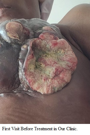 image showing breast cancer