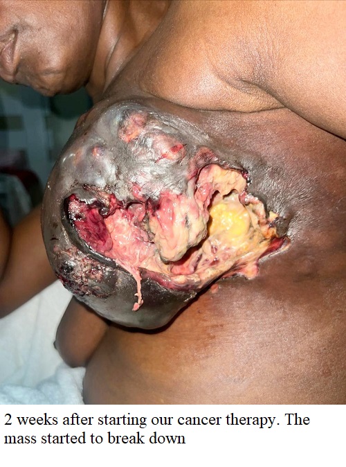 cancerous-breast-wound