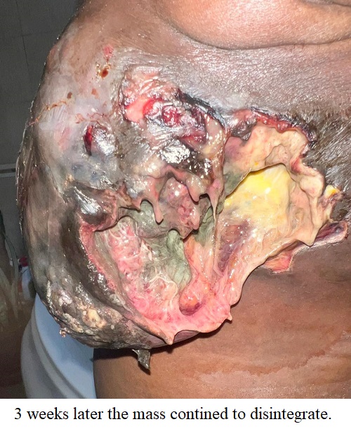 chronic-breast-cancer-wound