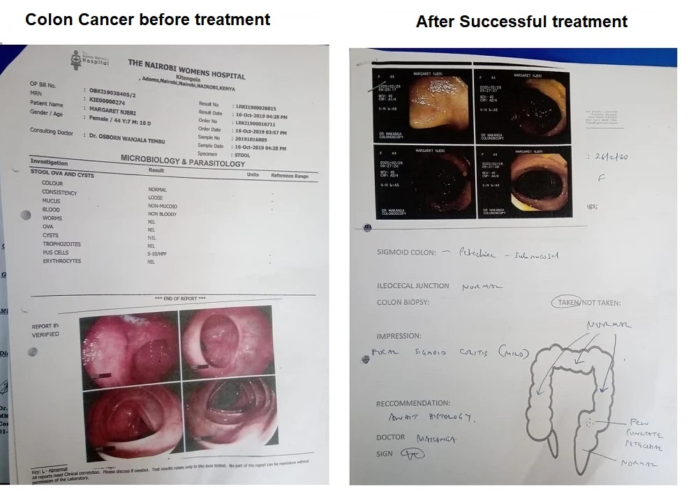 Best natural herbal cancer treatment